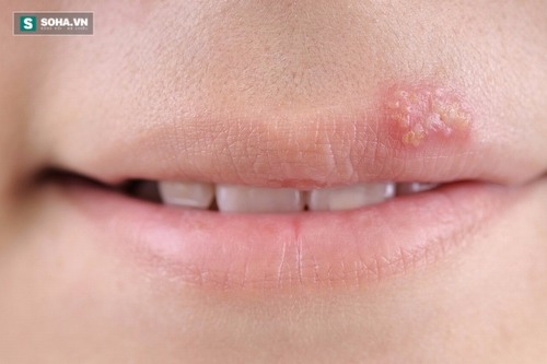 Cảnh giác với 5 căn bệnh nguy hiểm lây nhiễm qua một nụ hôn