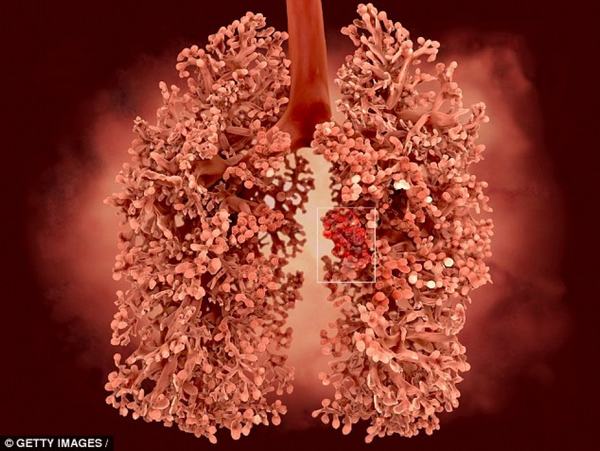 Xét nghiệm máu có thể phát hiện ung thư phổi trước 5 năm