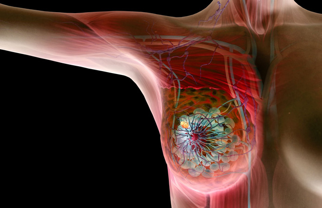Nhổ lông nách bằng nhíp nguy cơ dẫn đến ung thư vú